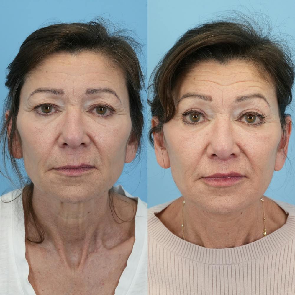 Facelift Before & After Gallery - Patient 414850 - Image 1