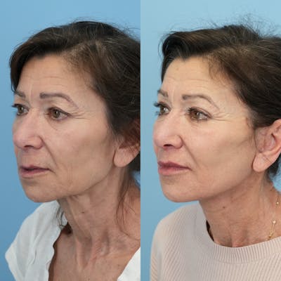 Facelift Before & After Gallery - Patient 414850 - Image 4