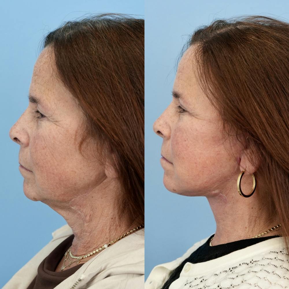 Facelift Before & After Gallery - Patient 400742 - Image 5