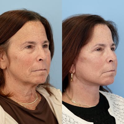 Facelift Before & After Gallery - Patient 400742 - Image 2