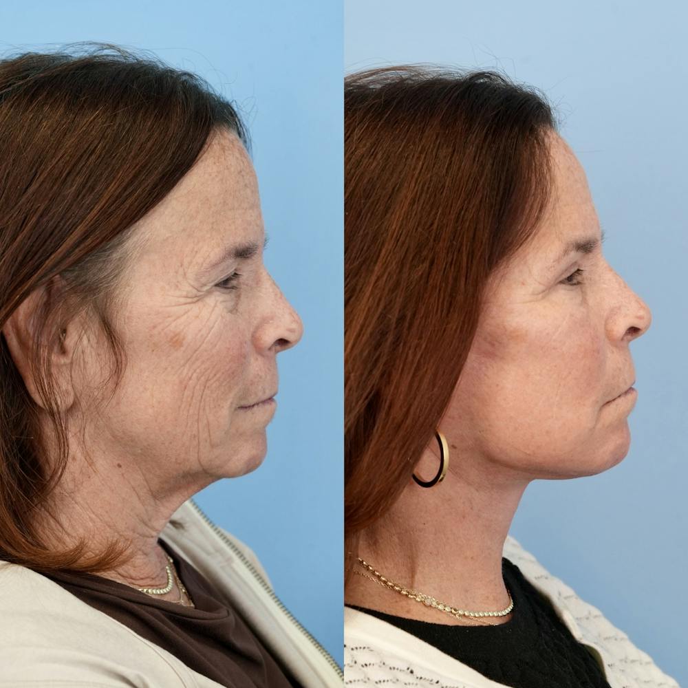 Facelift Before & After Gallery - Patient 400742 - Image 3