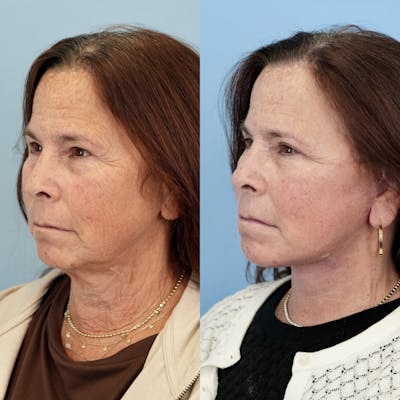 Facelift Before & After Gallery - Patient 400742 - Image 4
