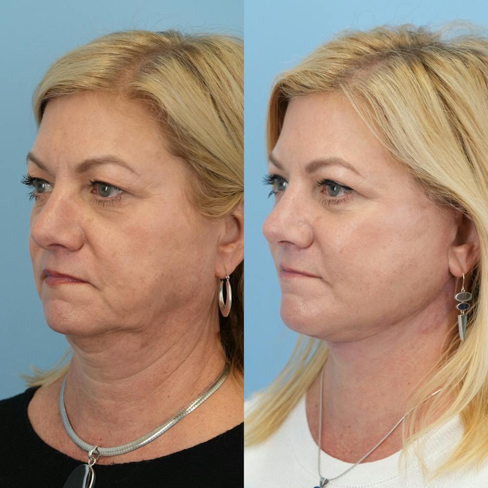 Facelift Before & After Gallery - Patient 655750 - Image 4