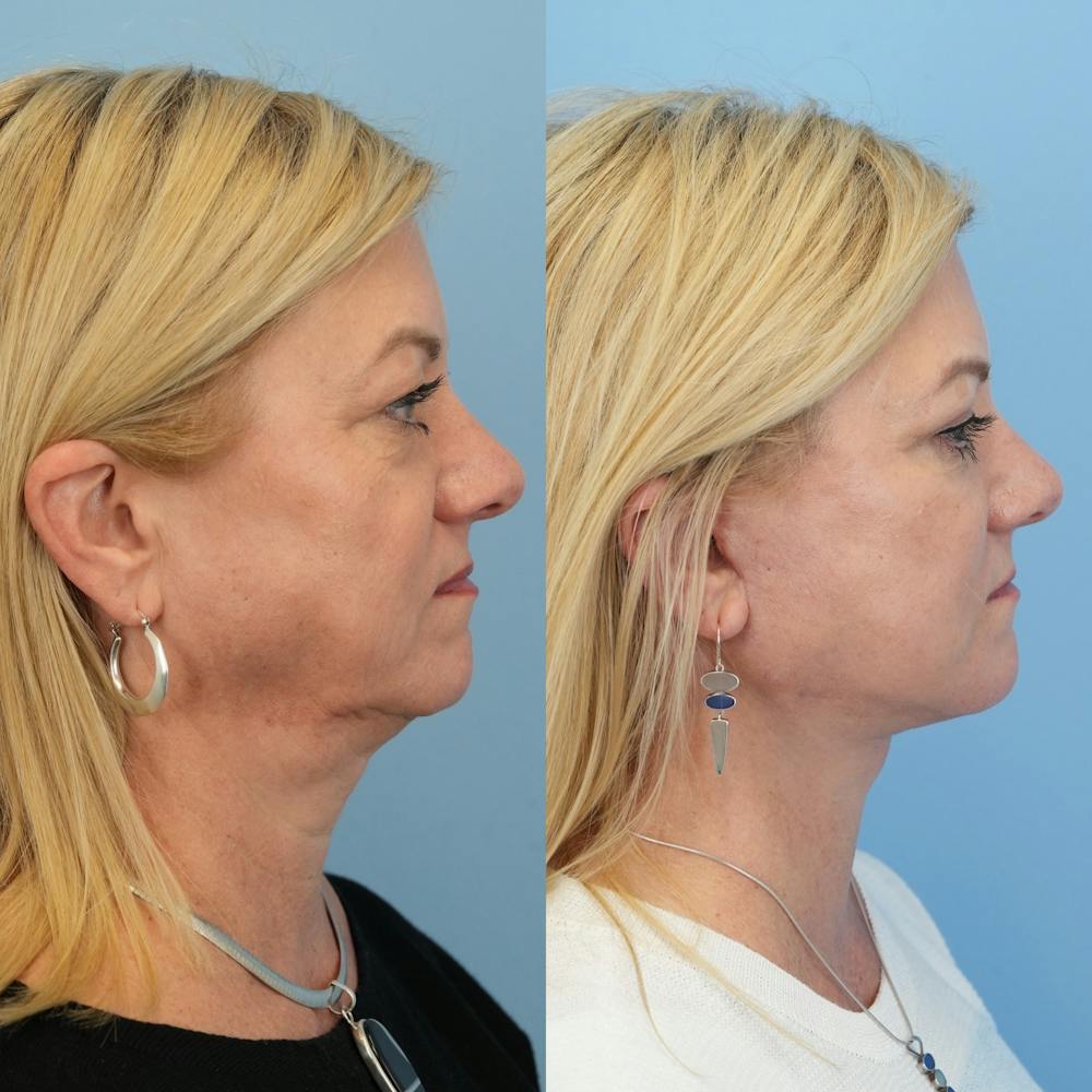 Facelift Before & After Gallery - Patient 655750 - Image 3