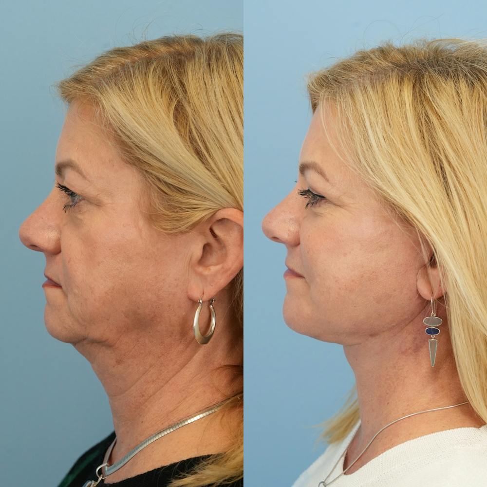 Facelift Before & After Gallery - Patient 655750 - Image 5