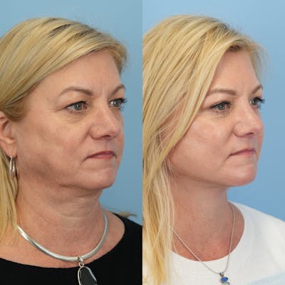Facelift Before & After Gallery - Patient 655750 - Image 2