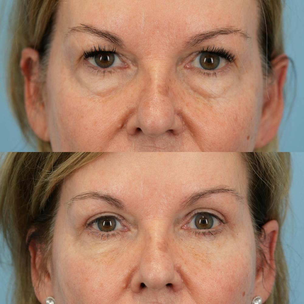 Blepharoplasty Before & After Gallery - Patient 232261 - Image 1