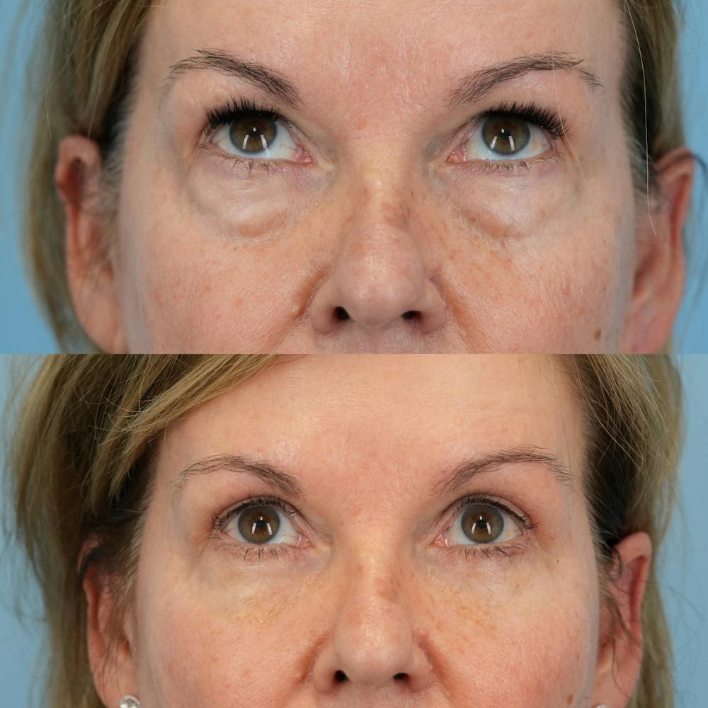 Blepharoplasty Before & After Gallery - Patient 232261 - Image 2