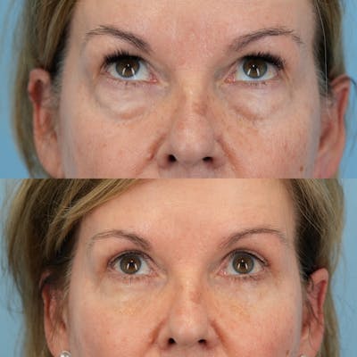 Blepharoplasty Before & After Gallery - Patient 232261 - Image 2