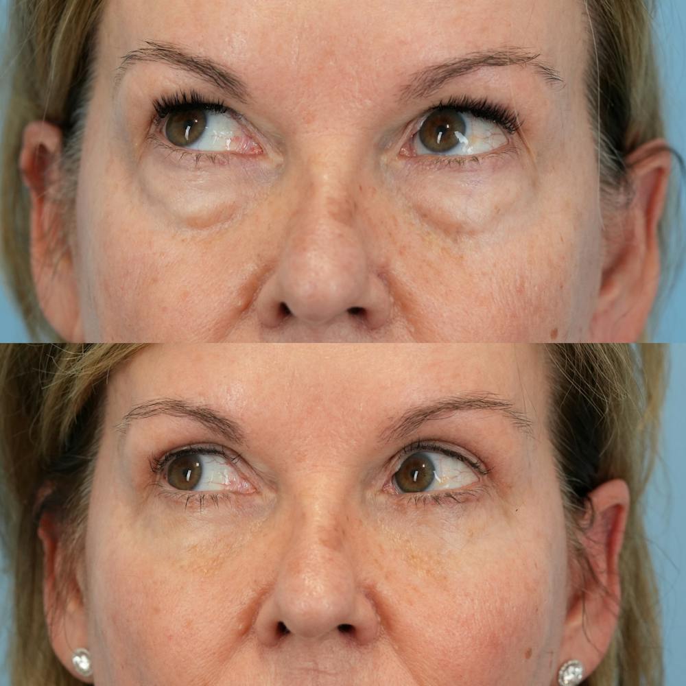 Blepharoplasty Before & After Gallery - Patient 232261 - Image 4