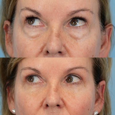 Blepharoplasty Before & After Gallery - Patient 232261 - Image 4