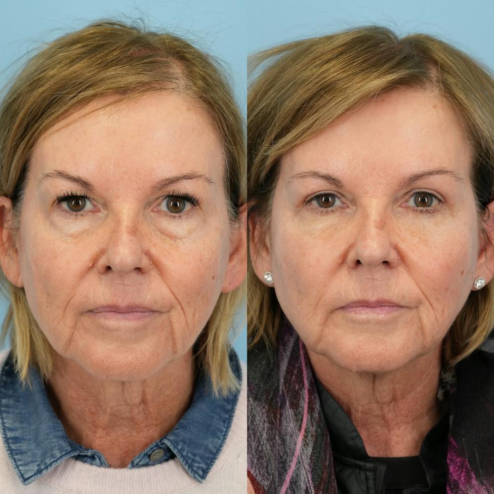 Blepharoplasty Before & After Gallery - Patient 232261 - Image 5