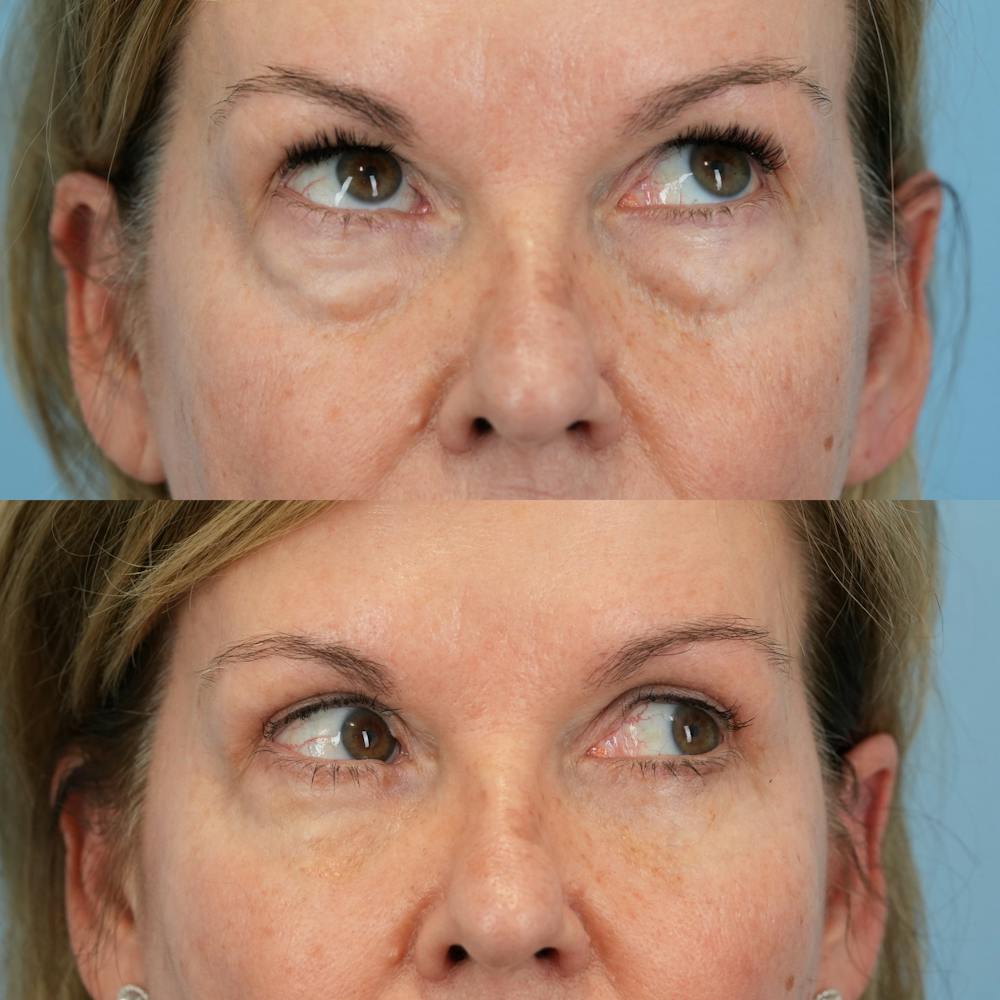 Blepharoplasty Before & After Gallery - Patient 232261 - Image 3