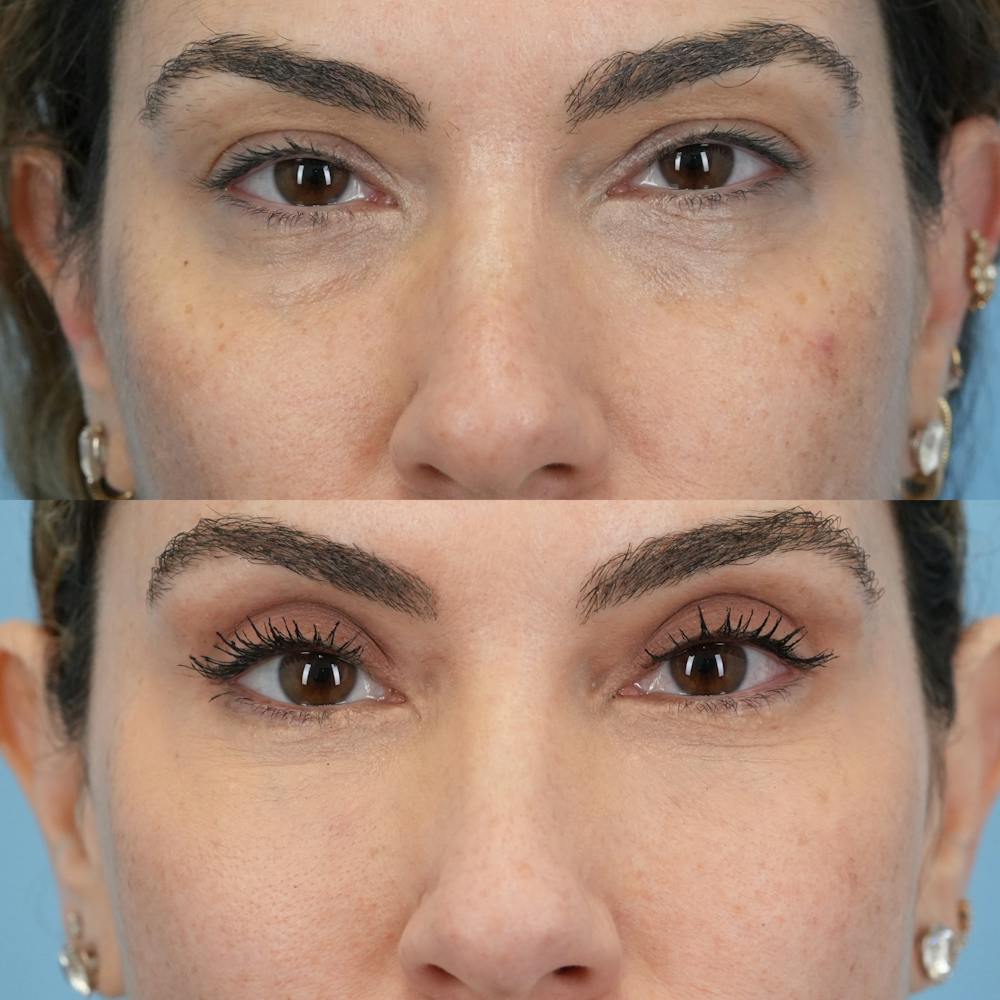 Lower Eyelids Before & After Gallery - Patient 119739 - Image 1