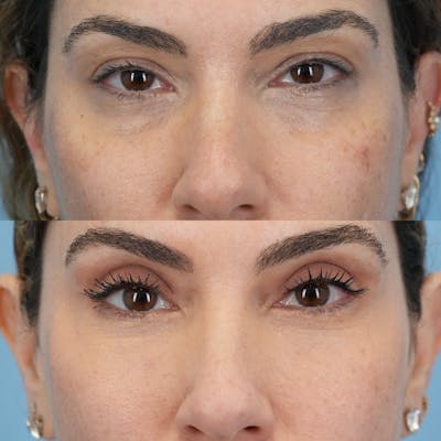 Lower Eyelids Before & After Gallery - Patient 119739 - Image 1