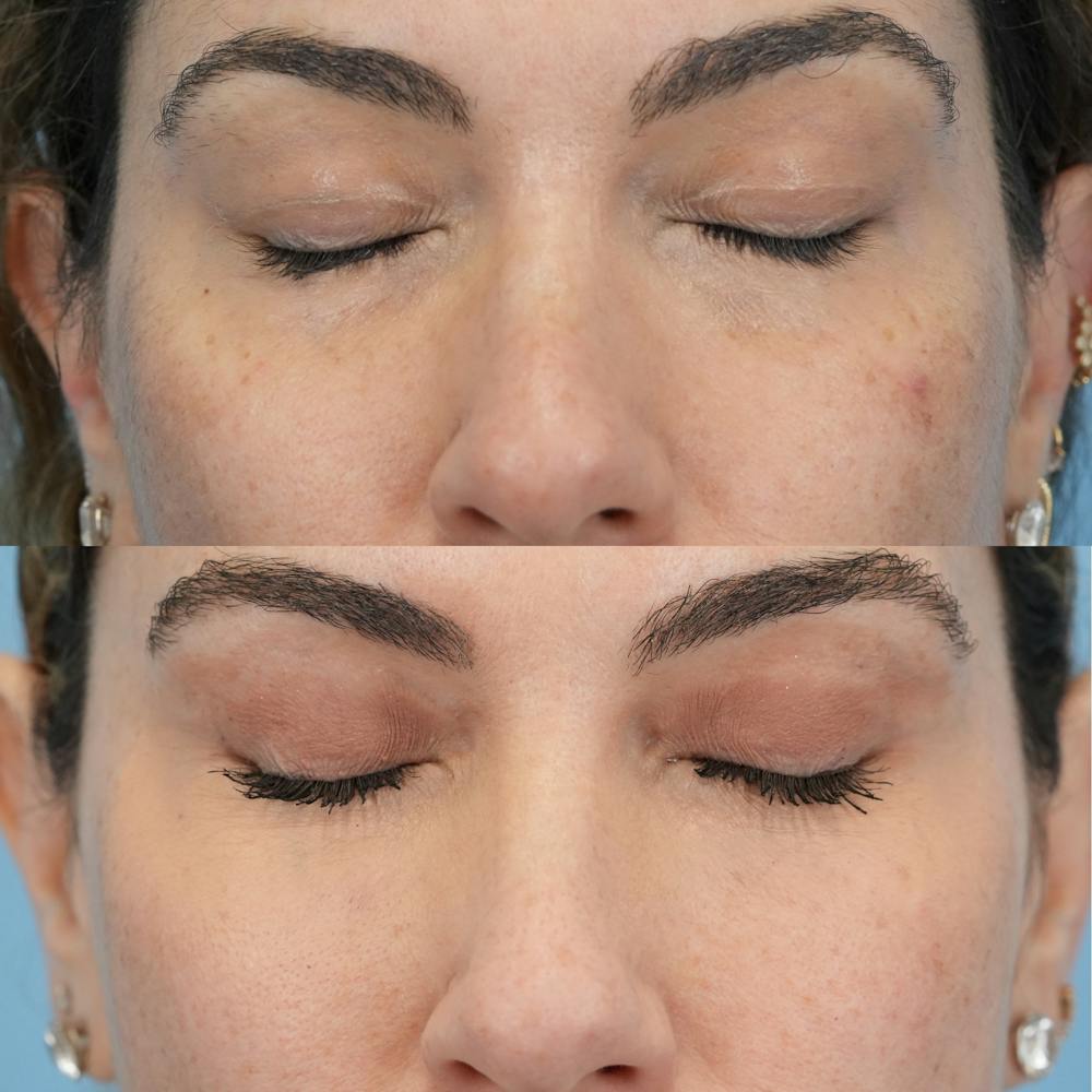 Lower Eyelids Before & After Gallery - Patient 119739 - Image 5