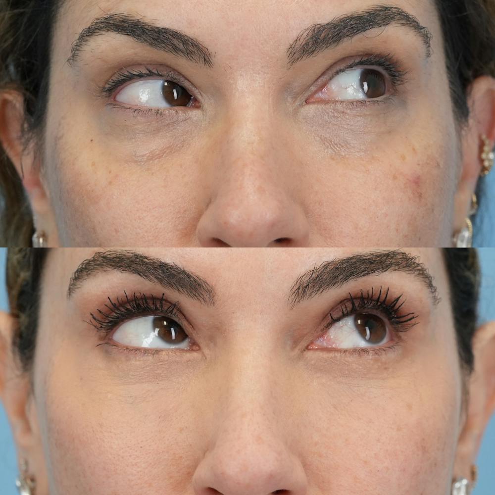 Lower Eyelids Before & After Gallery - Patient 119739 - Image 3