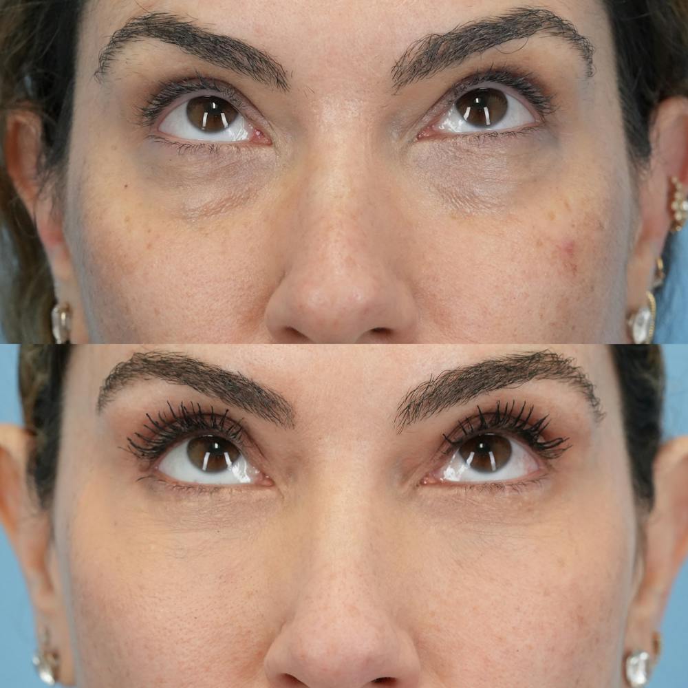 Lower Eyelids Before & After Gallery - Patient 119739 - Image 2