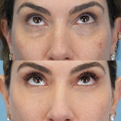 Lower Eyelids Before & After Gallery - Patient 119739 - Image 2