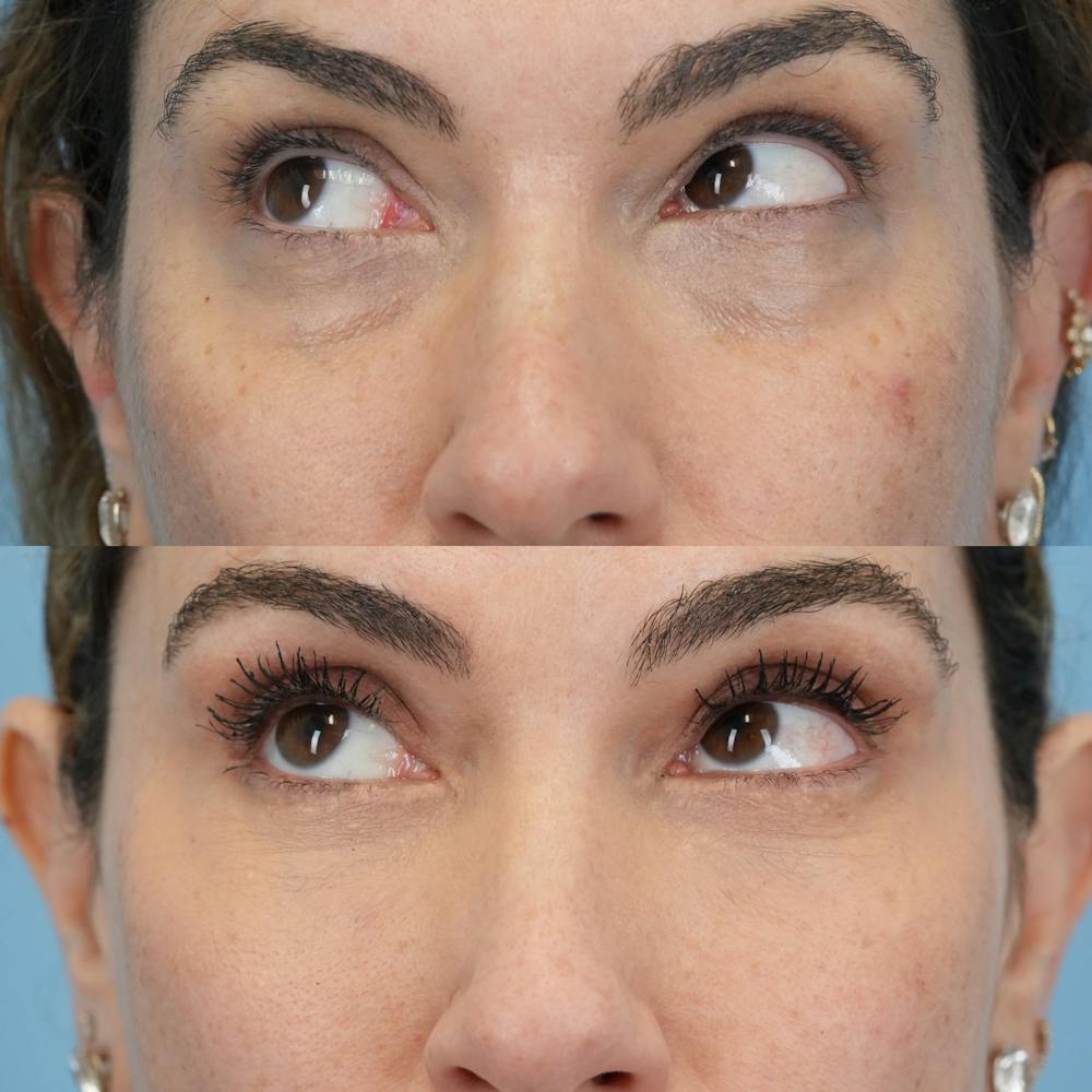 Lower Eyelids Before & After Gallery - Patient 119739 - Image 4