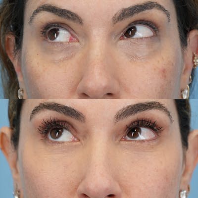 Lower Eyelids Before & After Gallery - Patient 119739 - Image 4