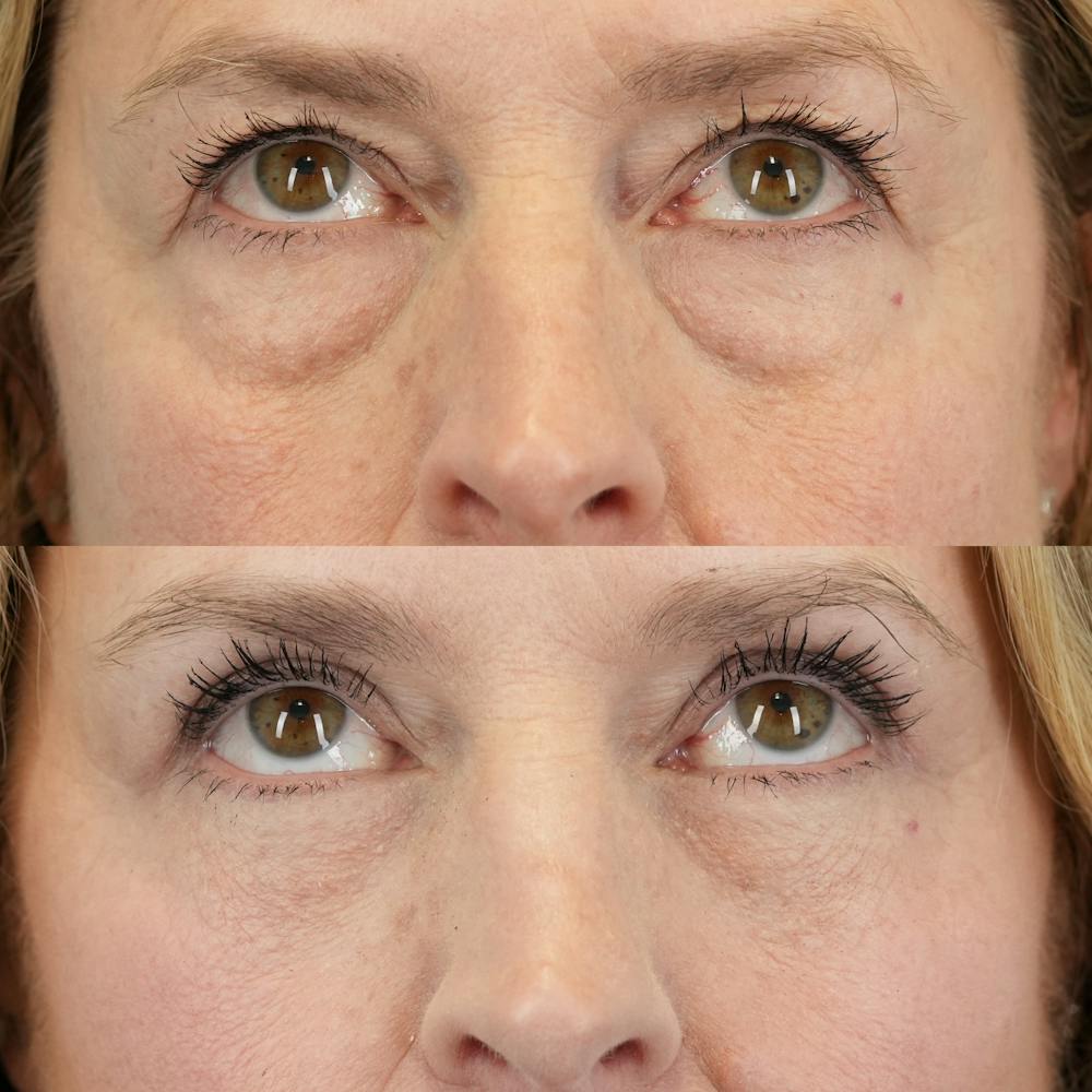Upper Eyelids Before & After Gallery - Patient 102041 - Image 2