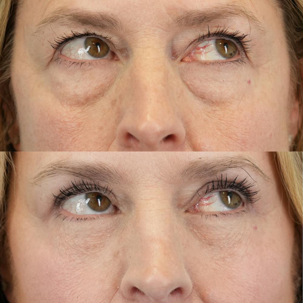 Upper Eyelids Before & After Gallery - Patient 102041 - Image 3