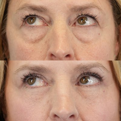 Upper Eyelids Before & After Gallery - Patient 102041 - Image 4