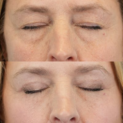 Fat Grafting Before & After Gallery - Patient 119096 - Image 4
