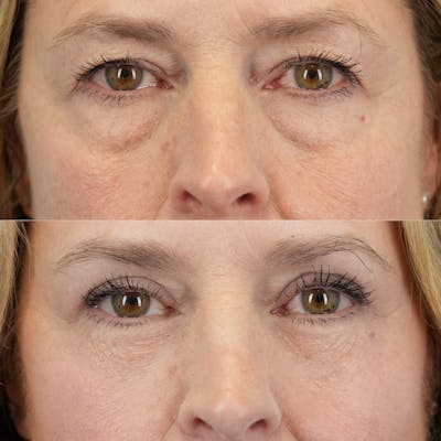 Lower Eyelids Before & After Gallery - Patient 395954 - Image 1