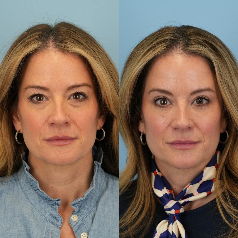 Blepharoplasty Before & After Gallery - Patient 262973 - Image 6