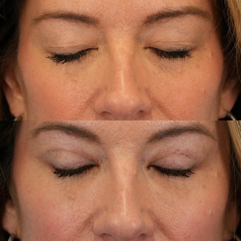Blepharoplasty Before & After Gallery - Patient 262973 - Image 3
