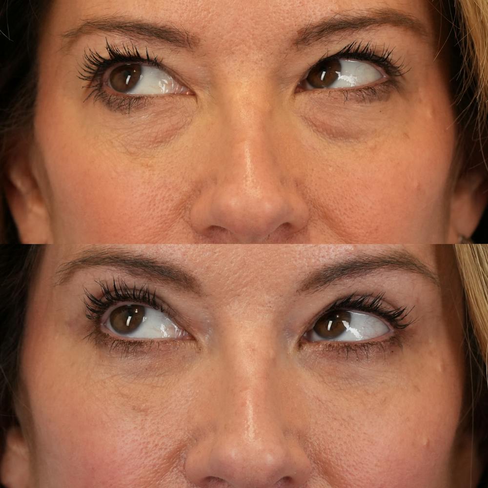 Blepharoplasty Before & After Gallery - Patient 262973 - Image 5