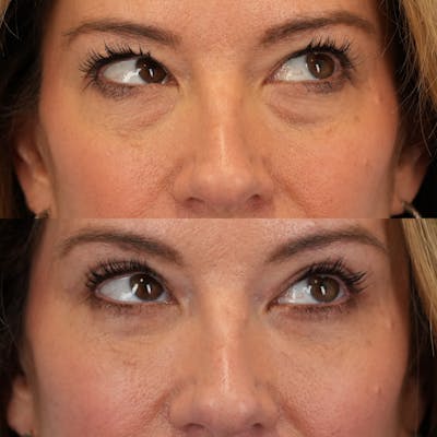 Blepharoplasty Before & After Gallery - Patient 262973 - Image 4