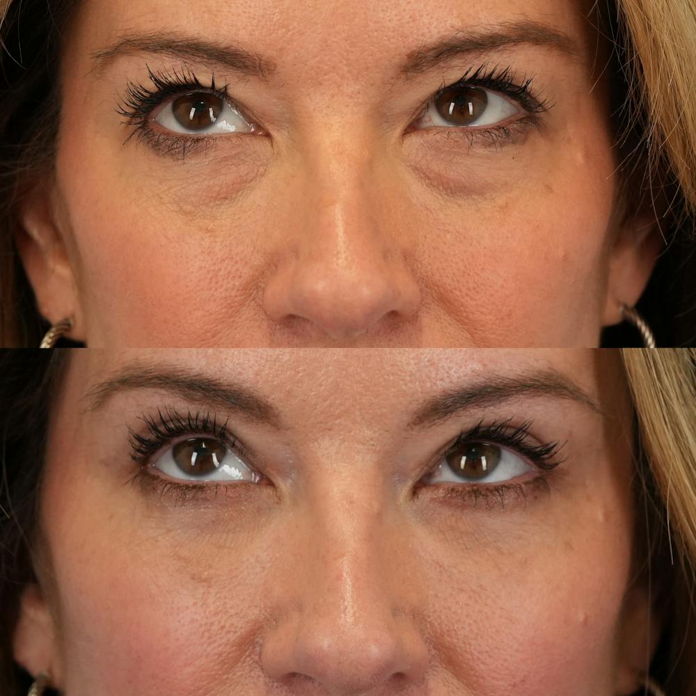 Blepharoplasty Before & After Gallery - Patient 262973 - Image 2