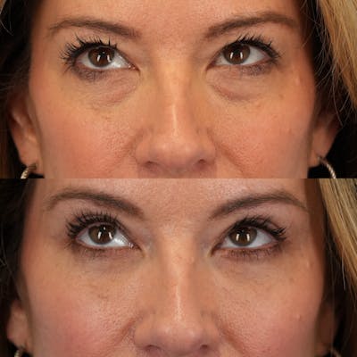 Blepharoplasty Before & After Gallery - Patient 262973 - Image 2
