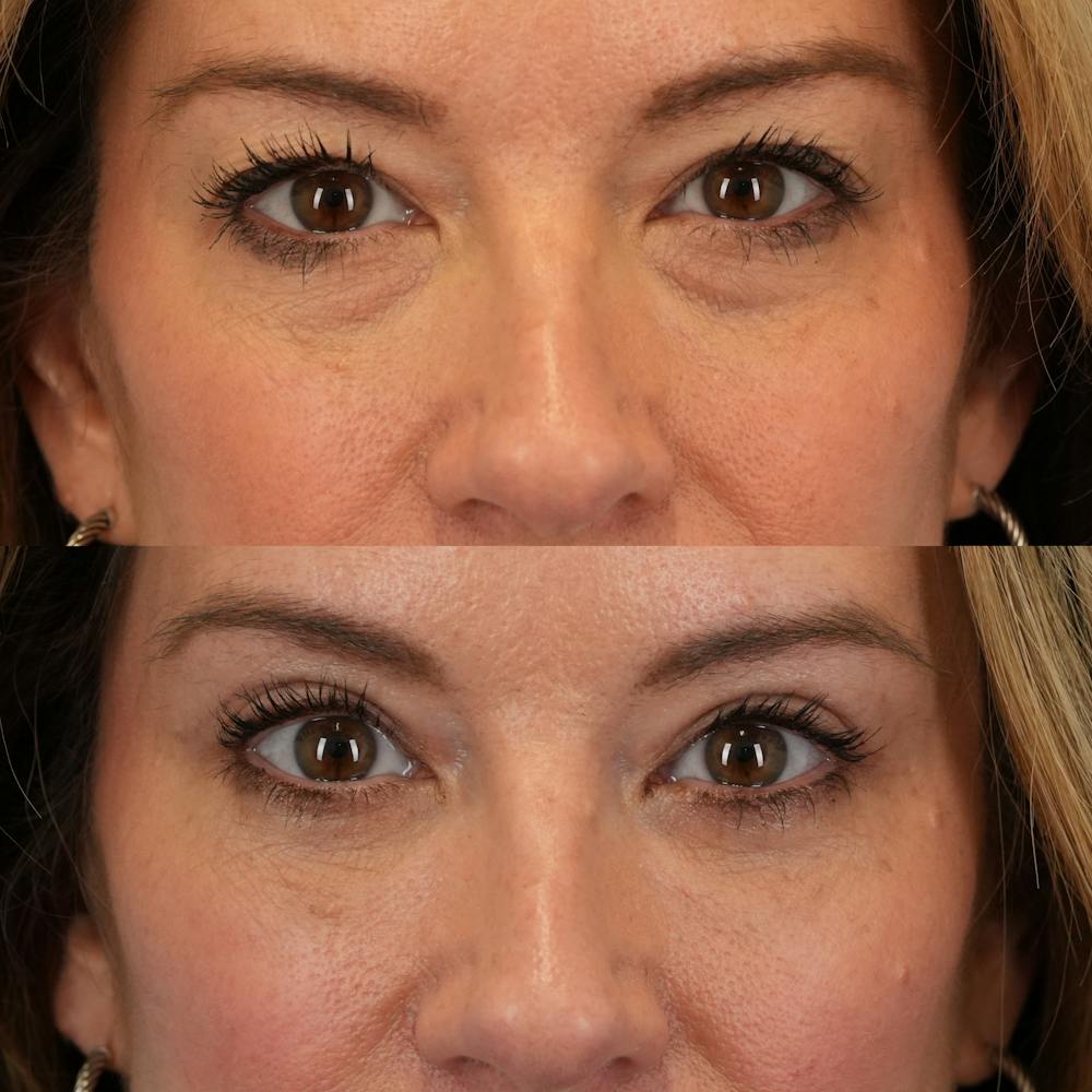 Blepharoplasty Before & After Gallery - Patient 262973 - Image 1