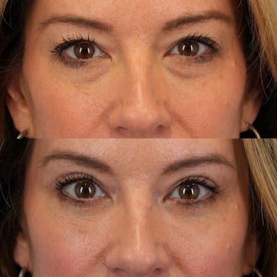 Lower Eyelids Before & After Gallery - Patient 761483 - Image 1