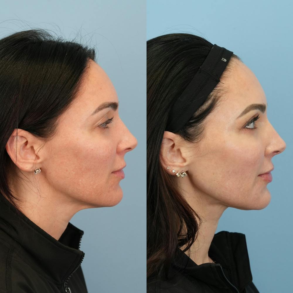 Fat Grafting Before & After Gallery - Patient 414898 - Image 3