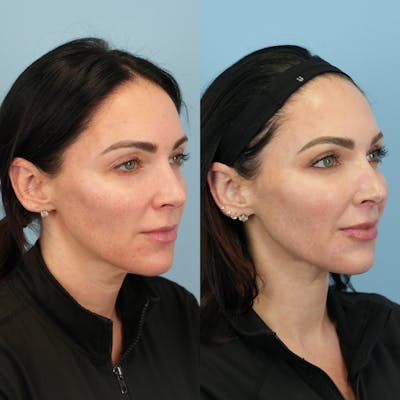 Fat Grafting Before & After Gallery - Patient 414898 - Image 2