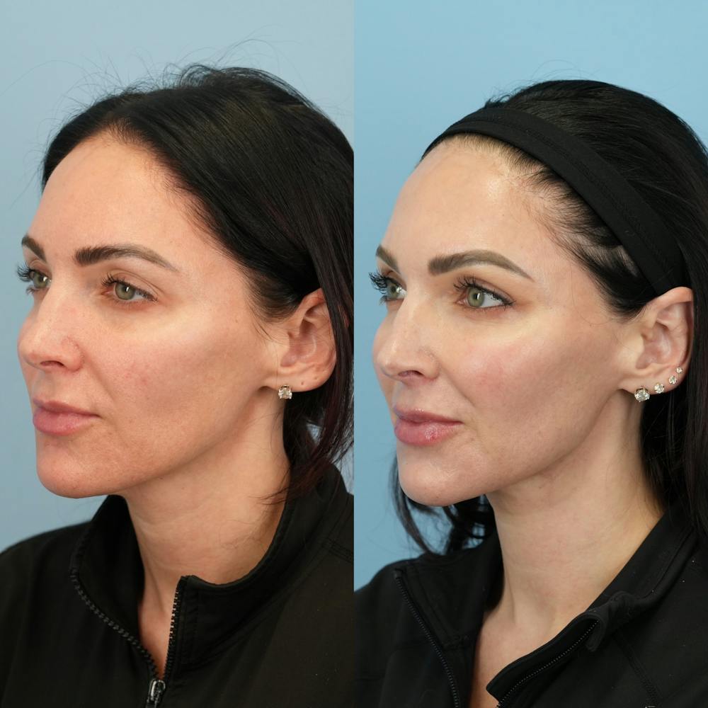 Fat Grafting Before & After Gallery - Patient 414898 - Image 4