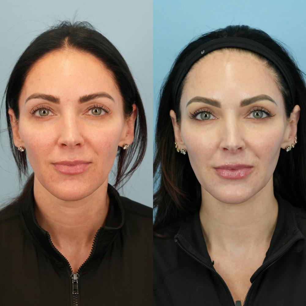 Fat Grafting Before & After Gallery - Patient 414898 - Image 1