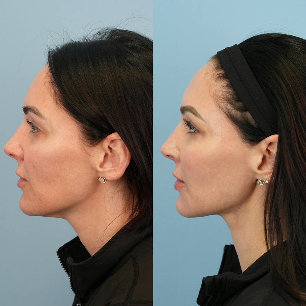 Fat Grafting Before & After Gallery - Patient 414898 - Image 5