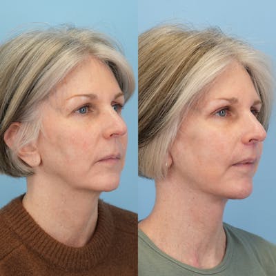 Facelift Before & After Gallery - Patient 367841 - Image 2
