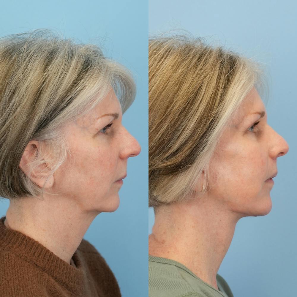 Facelift Before & After Gallery - Patient 367841 - Image 3