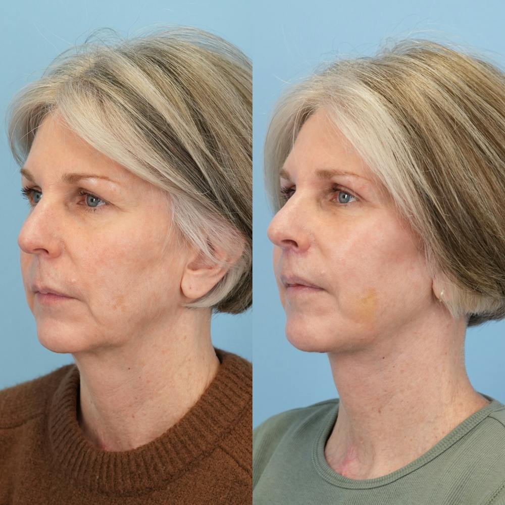 Facelift Before & After Gallery - Patient 367841 - Image 4