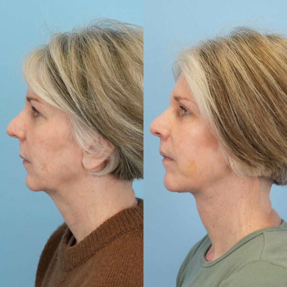 Facelift Before & After Gallery - Patient 367841 - Image 5