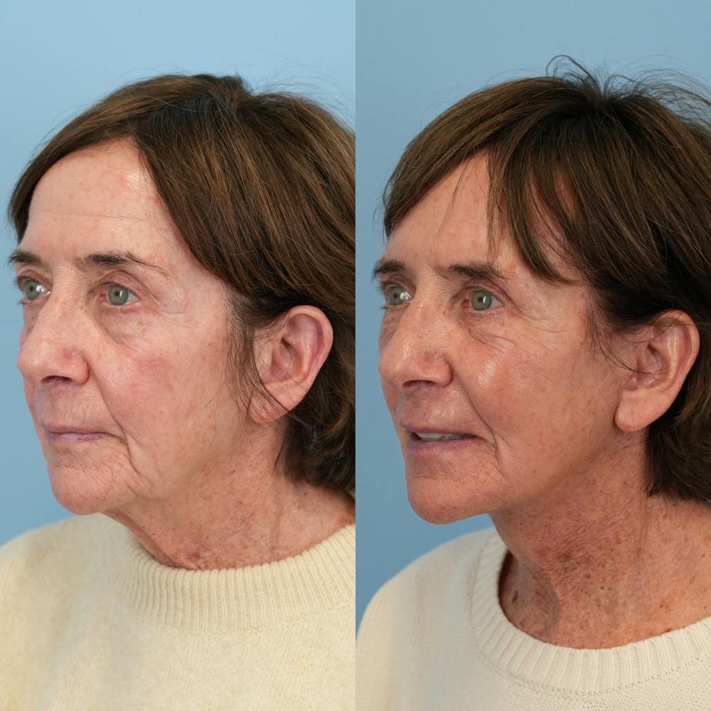 Facelift Before & After Gallery - Patient 117675 - Image 5