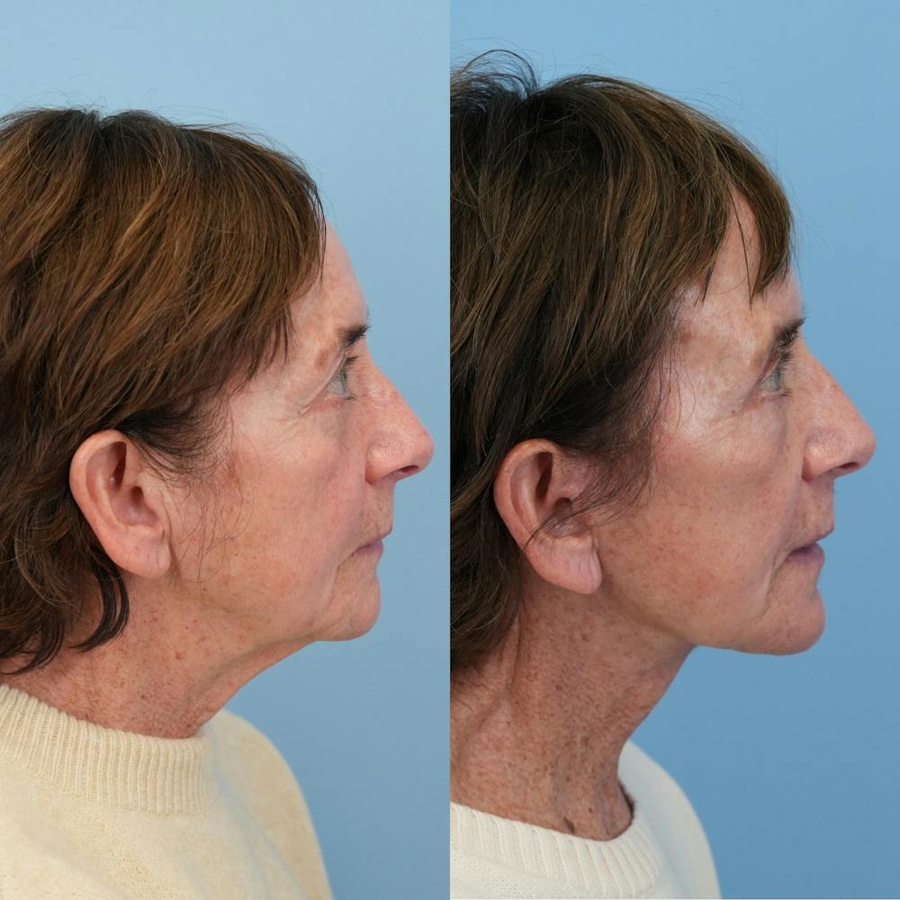 Facelift Before & After Gallery - Patient 117675 - Image 4