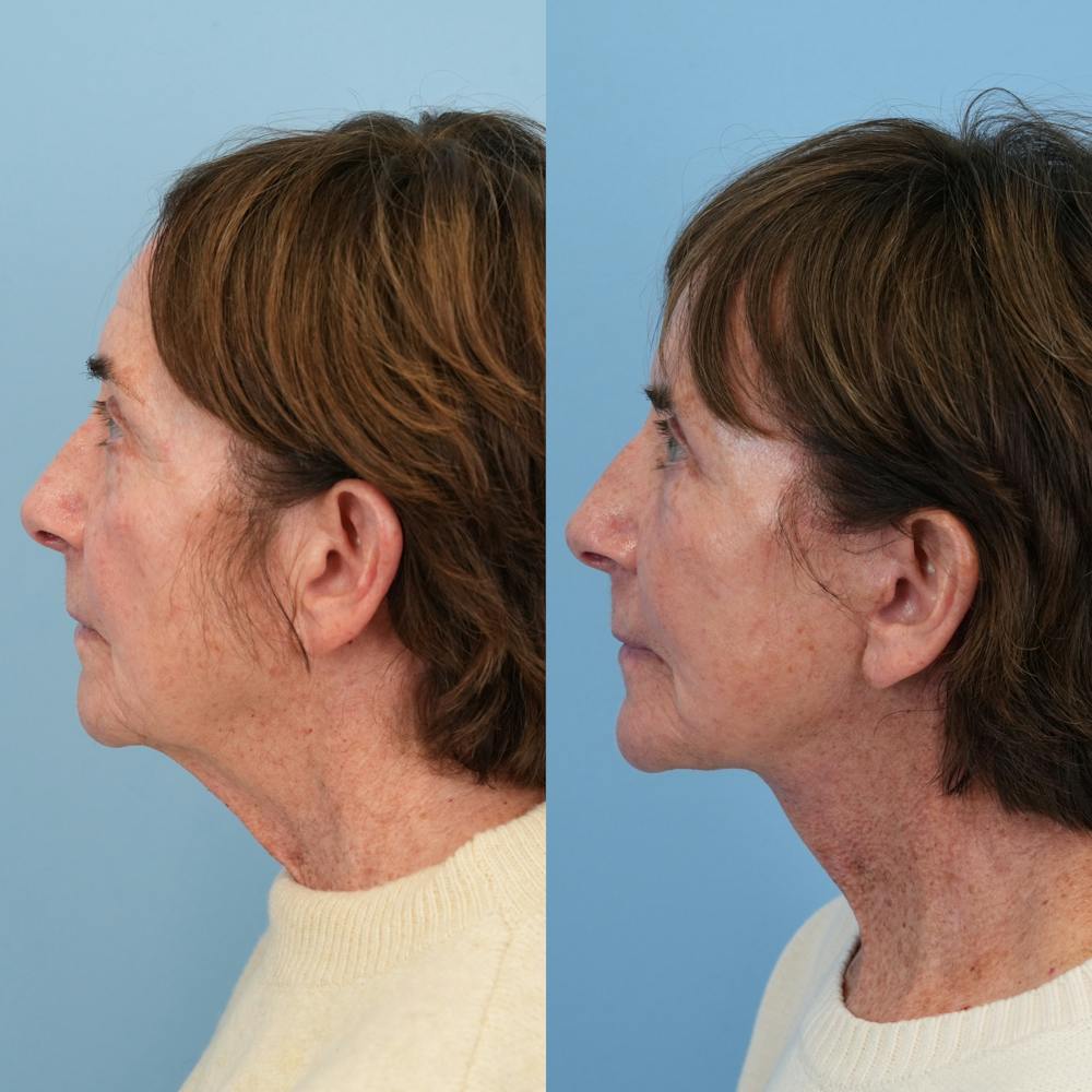 Facelift Before & After Gallery - Patient 117675 - Image 6